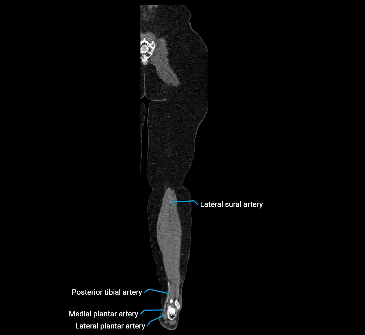 CTA lower limb coronal cross sectional anatomy labelled image _78 (2).webp